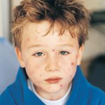 Molluscum contagiosum bērniem