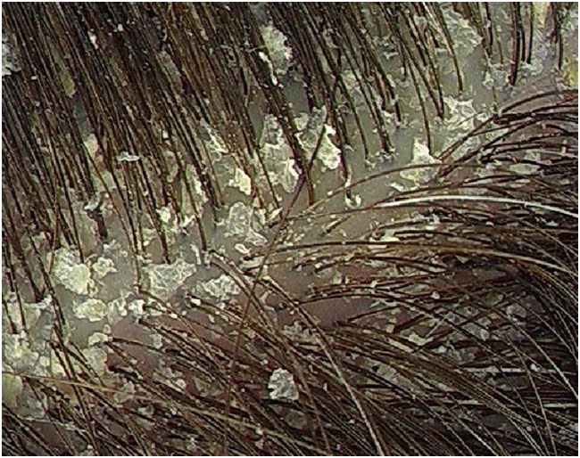 Kā atbrīvoties no blaugznas