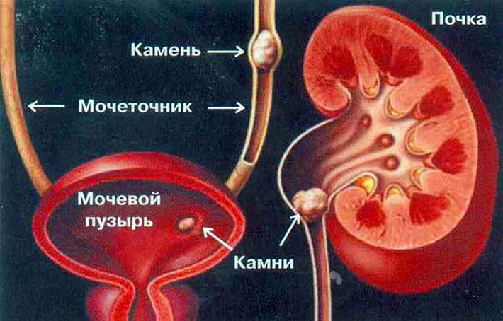 Nieru akmeņi: ārstēšana ar tautas līdzekļiem