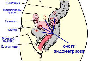 Endometrioze: ārstēšana ar tautas līdzekļiem