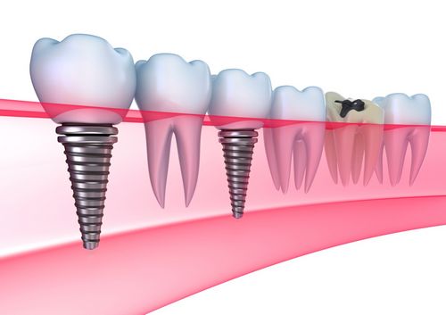 Vai zobu implantācija ir greznība vai nepieciešamība? 