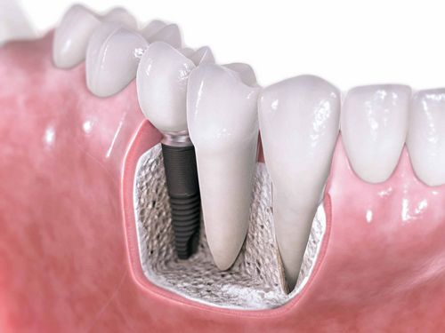 Vai zobu implantācija ir greznība vai nepieciešamība? 
