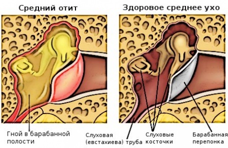 Kā ārstēt otiti mājās?