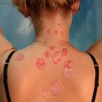Kā ārstēt psoriāzi? Kā ārstēt psoriāzi?