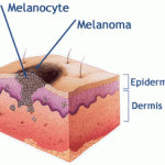 Ādas melanoma
