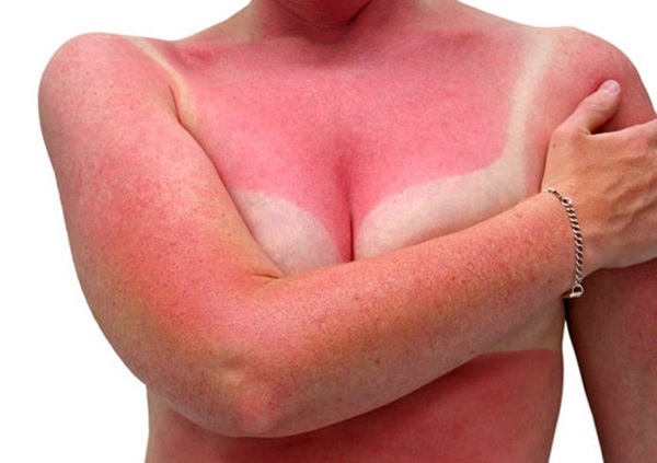 Sunburn āda