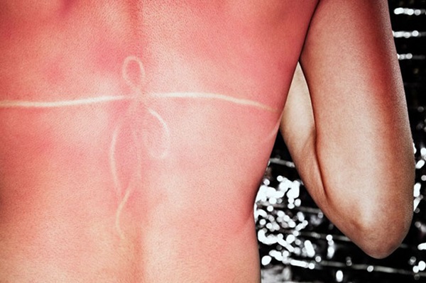 Sunburn āda