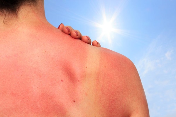 Sunburn āda