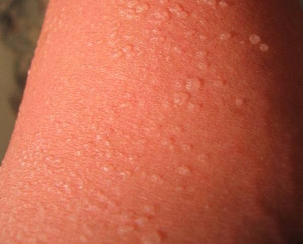 Sunburn āda