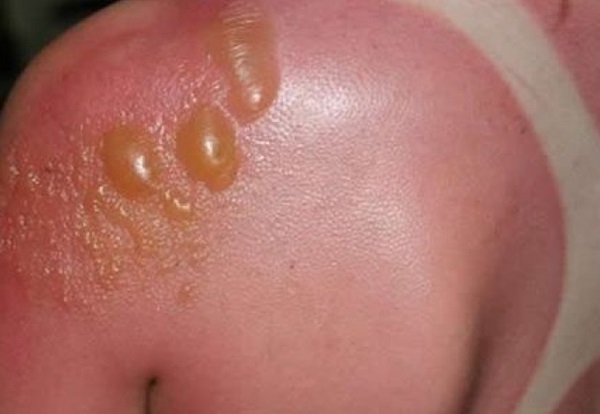 Sunburn āda