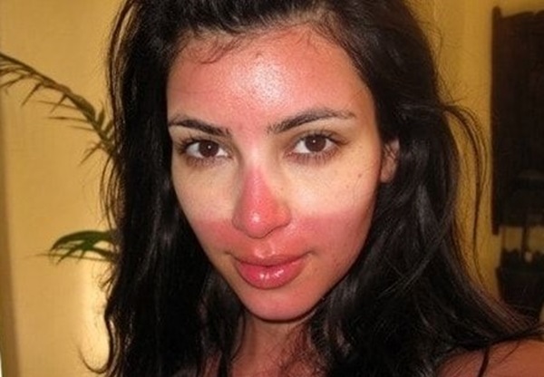 Sunburn āda