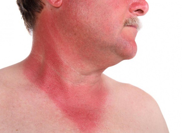 Sunburn āda